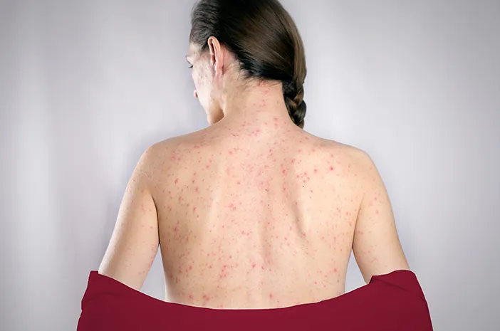 Mengenal Lebih Dekat Torsobella Virus: Apa Itu dan Bagaimana Cara Mengatasinya?