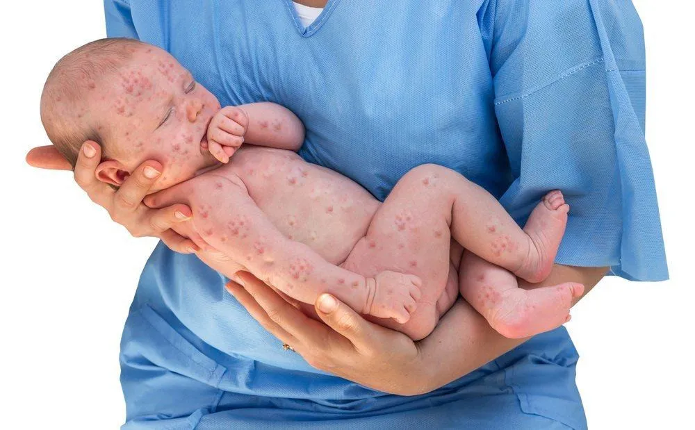 Virus Torsobela: Bahaya Makanan Mentah bagi Ibu Hamil